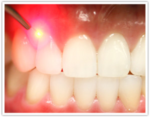 laser-dentistry-300x235