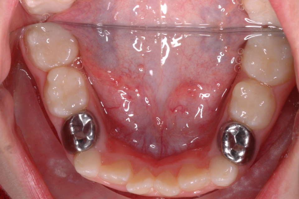 Pulpectomy Dental Treatment Dental Clinic in Kukatpally