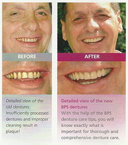 BPS Dentures in Hyderabad