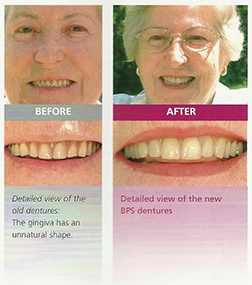 BPS Dentures in Hyderabad