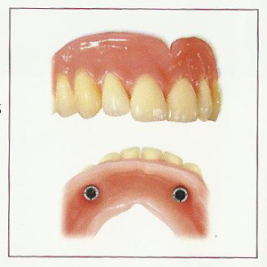 Combination Dentures