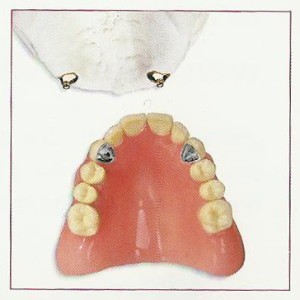 Over Denture