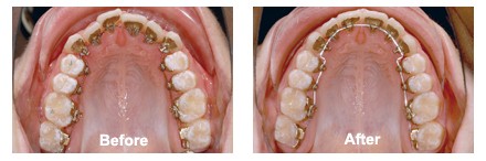 Lingual Braces Procedure