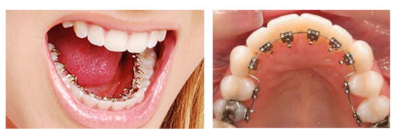 Lingual Braces Specialist Hyderabad