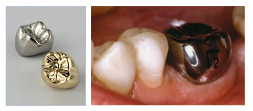 dental crown crowns metal resin teeth types expensive temporary fused other permanent most than they look porcelain less
