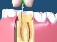 Pulpectomy Dental Treatment Hyderabad