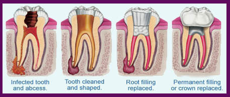 Root Canal Treatment Gachibowli Hyderabad