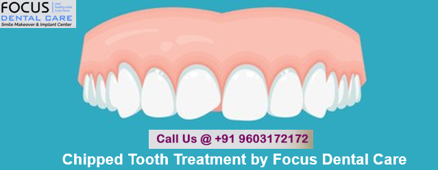 Chipped Tooth Treatment by Focus Dental Care