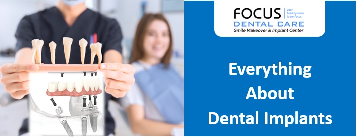 Everything about Dental Implants