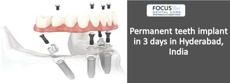 Permanent teeth implant in 3 days in Hyd