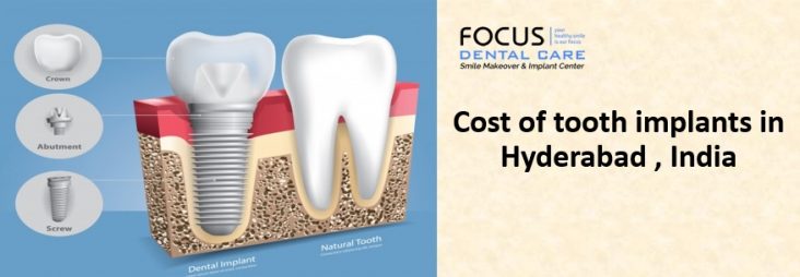 Cost of tooth implants in Hyderabad , India