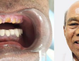Mr Reddy-Implant Rehabilitation