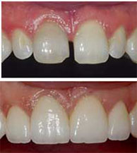 Composite Veneers