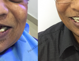 Mr. Narayana-Upper Arch Full Mouth Implants Rehabilitation