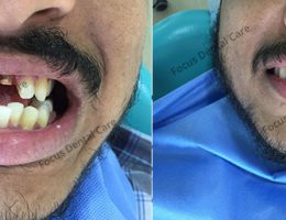 Cosmetic Correction Of Upper Front Teeth With Zirconia Crowns