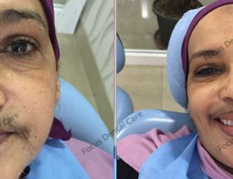 Full Mouth Dental Implants-Mrs Zenab , Minister From Somalia