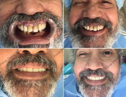 Full Mouth Implant Patient From Uk-Focus Dental Care