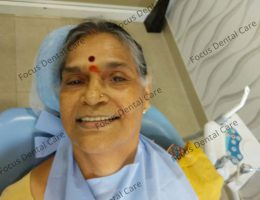 Mrs. Raja Kumari (Sanjose, Usa)-Full Mouth Implants