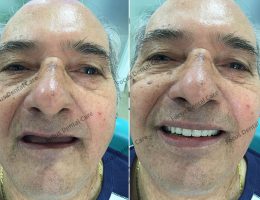 Full Mouth Rehabilitation With Implants – Focus Dental Care