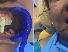 Dental Implants On Lower Left Side – Focus Dental Care