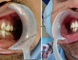 Laminate Veneers Treatment In Hyderabad, India