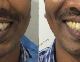 Lower Anterior Implants-Mr. Natraj