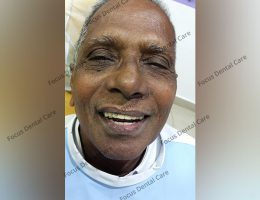 Mr. Rao (Guntur, India)-Lower Full Mouth Implants