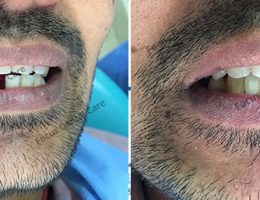 Missing Space Restored With Implant – Dr Ajay Krishna