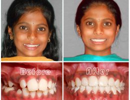 Orthodontic Correction Braces-Focus Dental Care