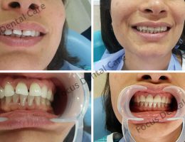 Smile Designing Treatment In India