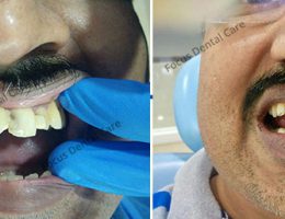 Smile Makeover Doctors In Hyderabad, India – Focus Dental Care