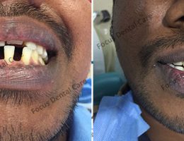 Smile Makeover Treatment – Focus Dental Care