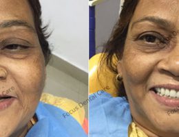 Upper Arch Full Mouth Implants In India-Mrs Renu