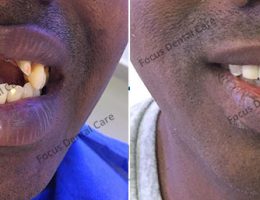 Upper Missing Teeth Restored With Implants – Focus Dental Care