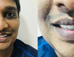 full-mouth-rehabilitation-with-dental-implants