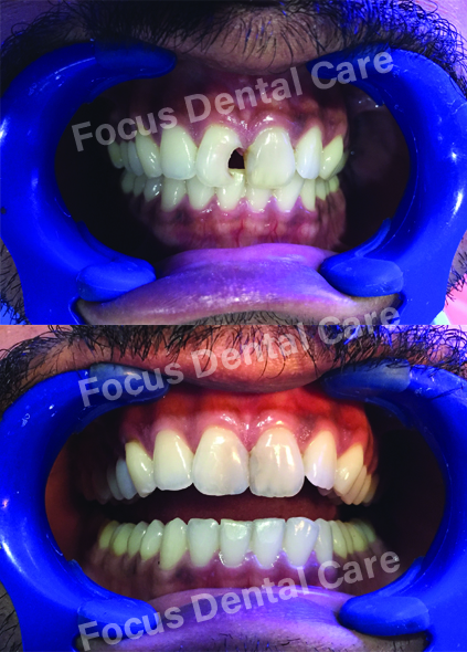 Dental Veneers in Hyderabad