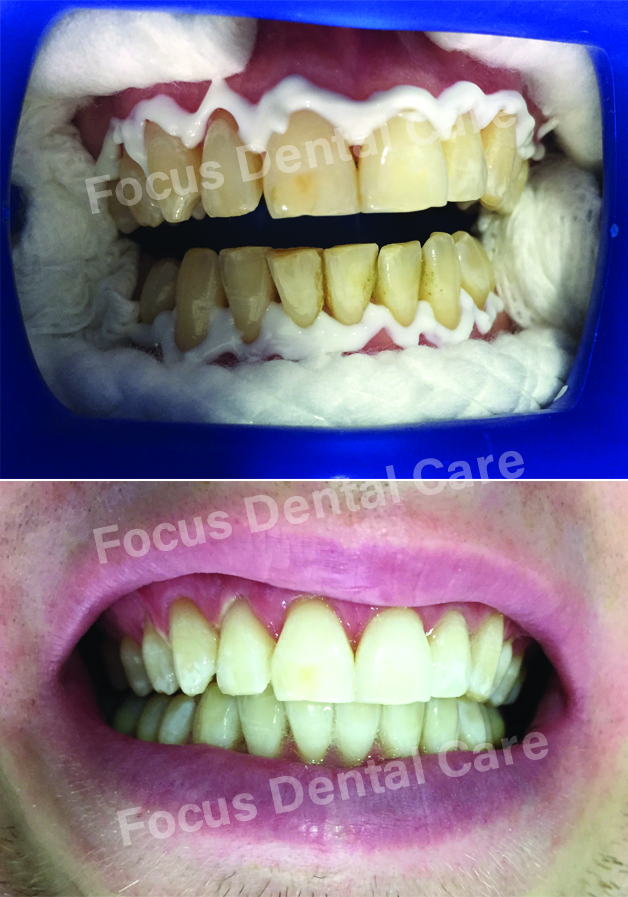 Teeth Whitening in Hyderbad