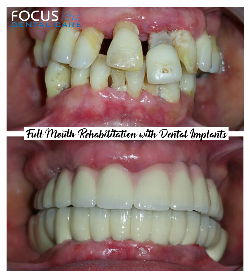 All on 6 Dental Implants in Hyderabad