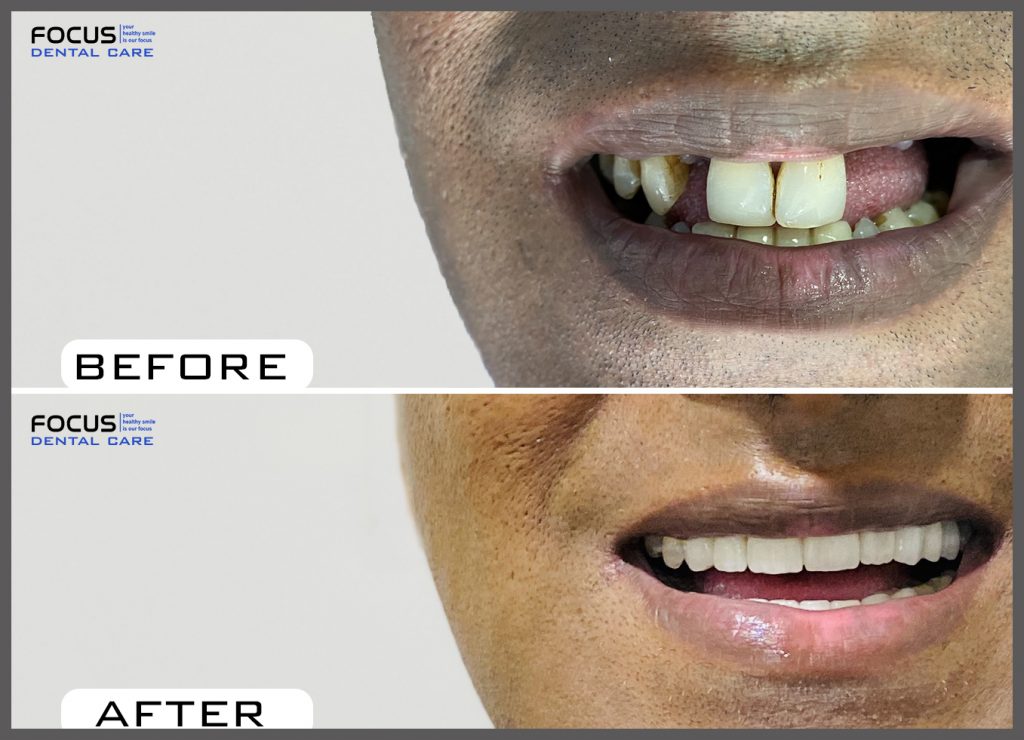 Full Mouth Dental Implants in Hyderabad