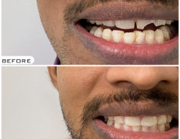 Smile Designing in Hyderabad