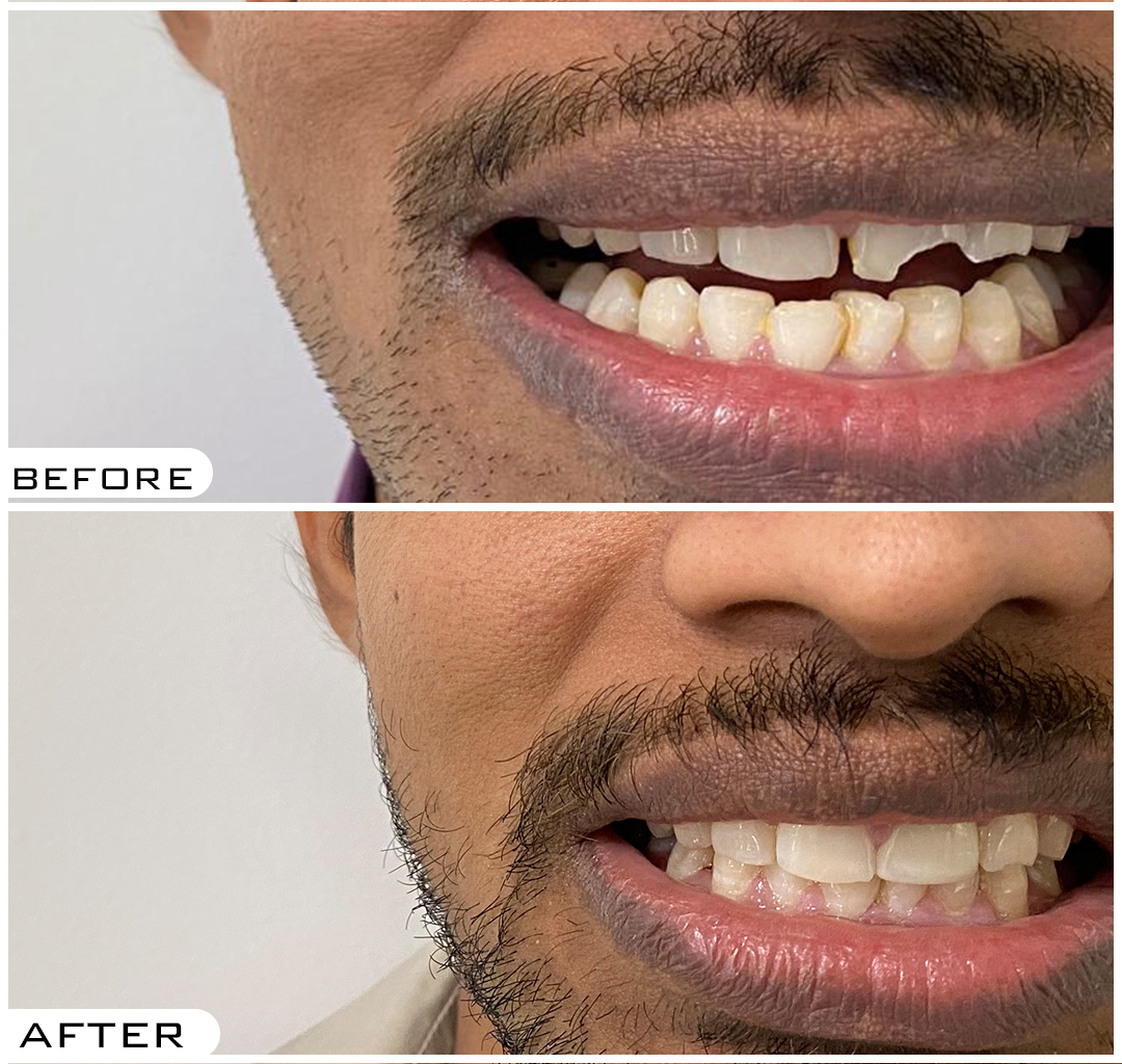 Smile Designing in Hyderabad