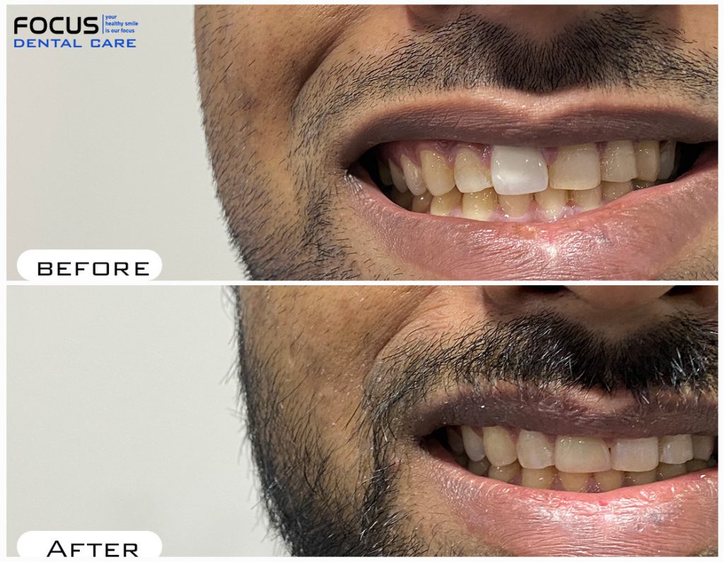 Dental Veneers in Hyderabad