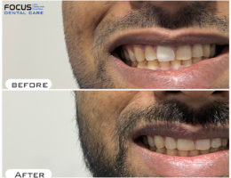 Dental Veneers in Hyderabad