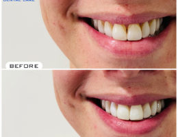 Dental Veneers in Hyderabad