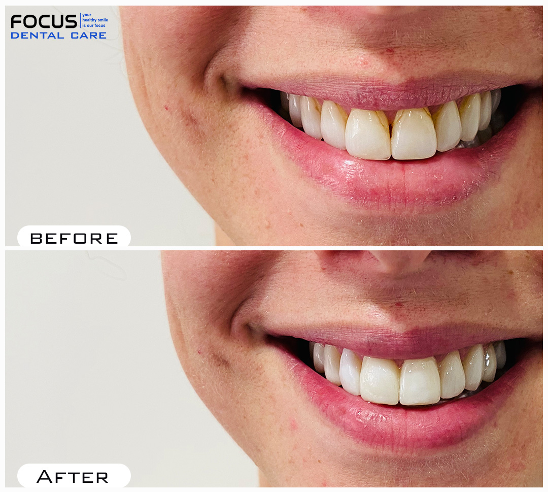 Dental Veneers in Hyderabad