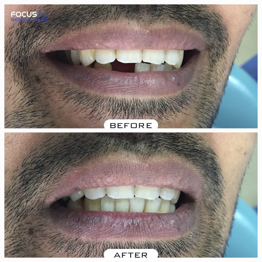 Single Tooth Dental Implants in Hyderabad Focus Dental Care