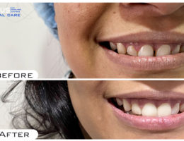 Dental Veneers in Hyderabad