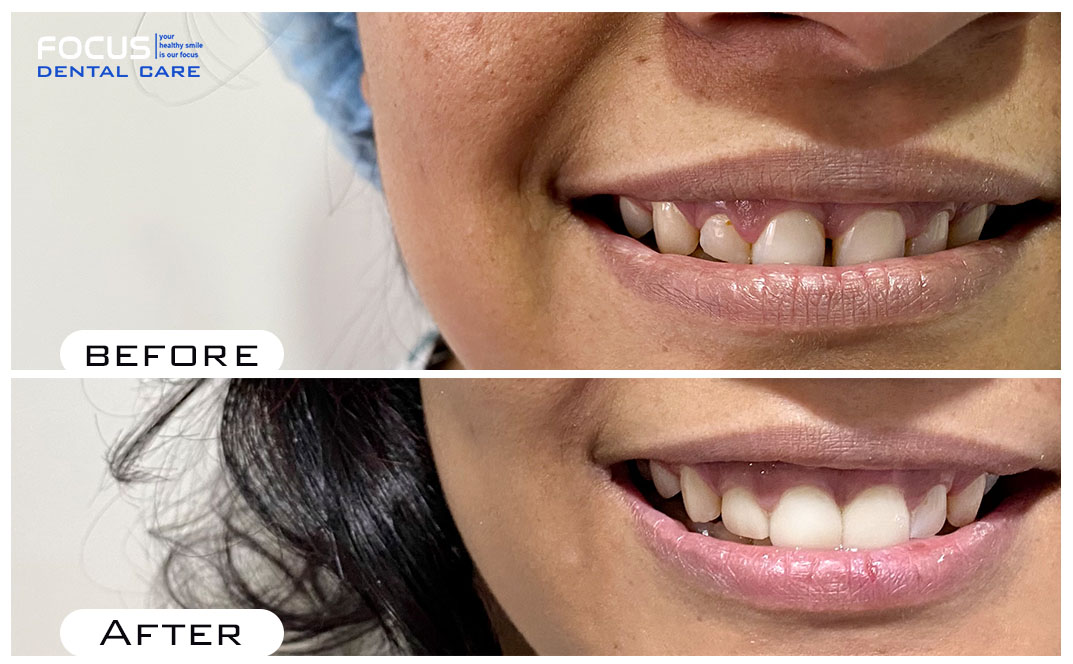 Dental Veneers in Hyderabad
