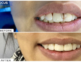 Dental Veneers in Hyderabad