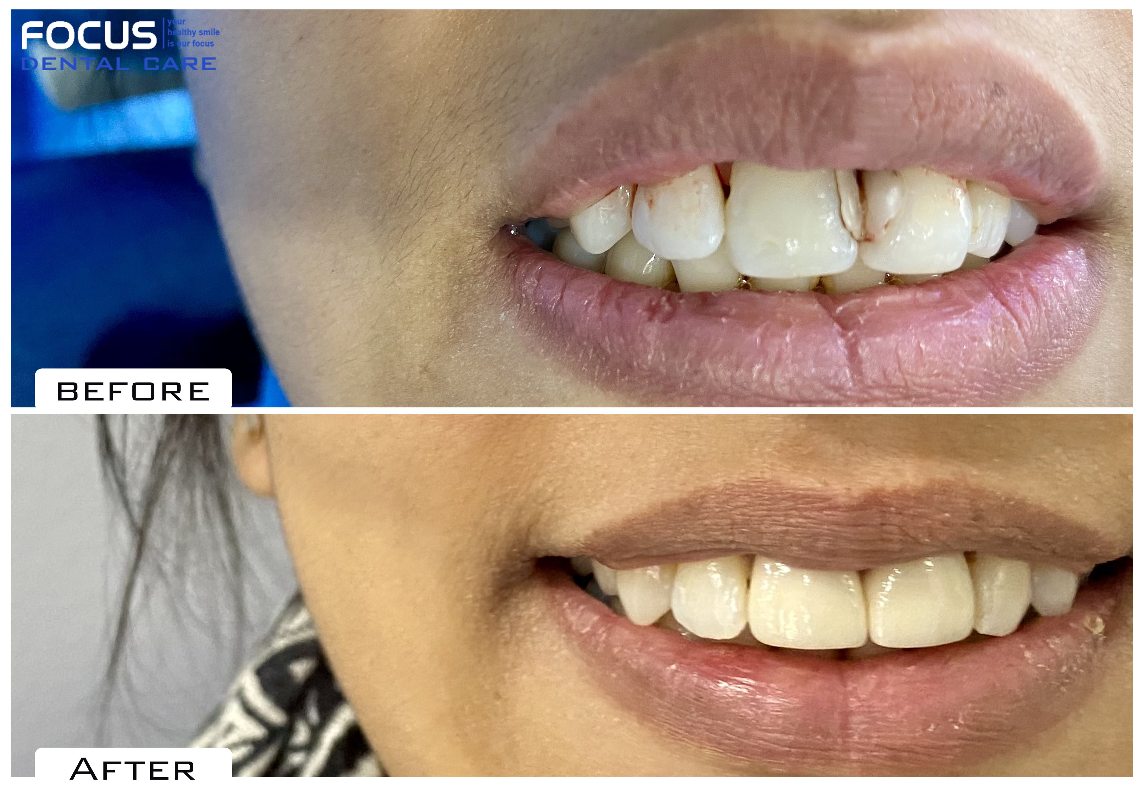 Dental Veneers in Hyderabad